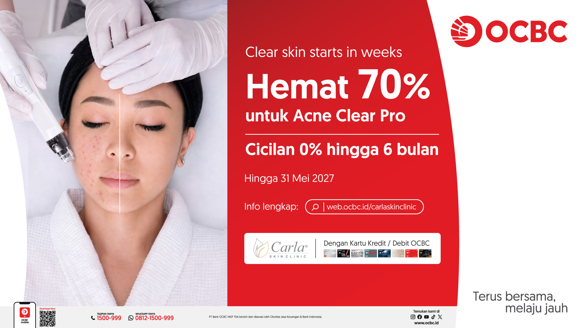 Promo Acne Clear Pro: Hemat 70% + Cicilan 0% Hingga 6 Bulan dengan Kartu OCBC