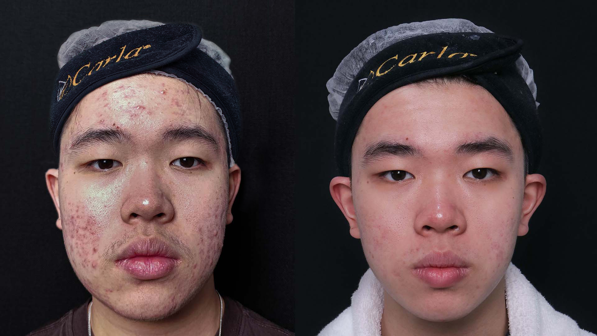Perjuangan Dylan Menghadapi Jerawat Remaja: Menemukan Kembali Kepercayaan Diri Bersama Acne Clear Pro di Carla Skin Clinic