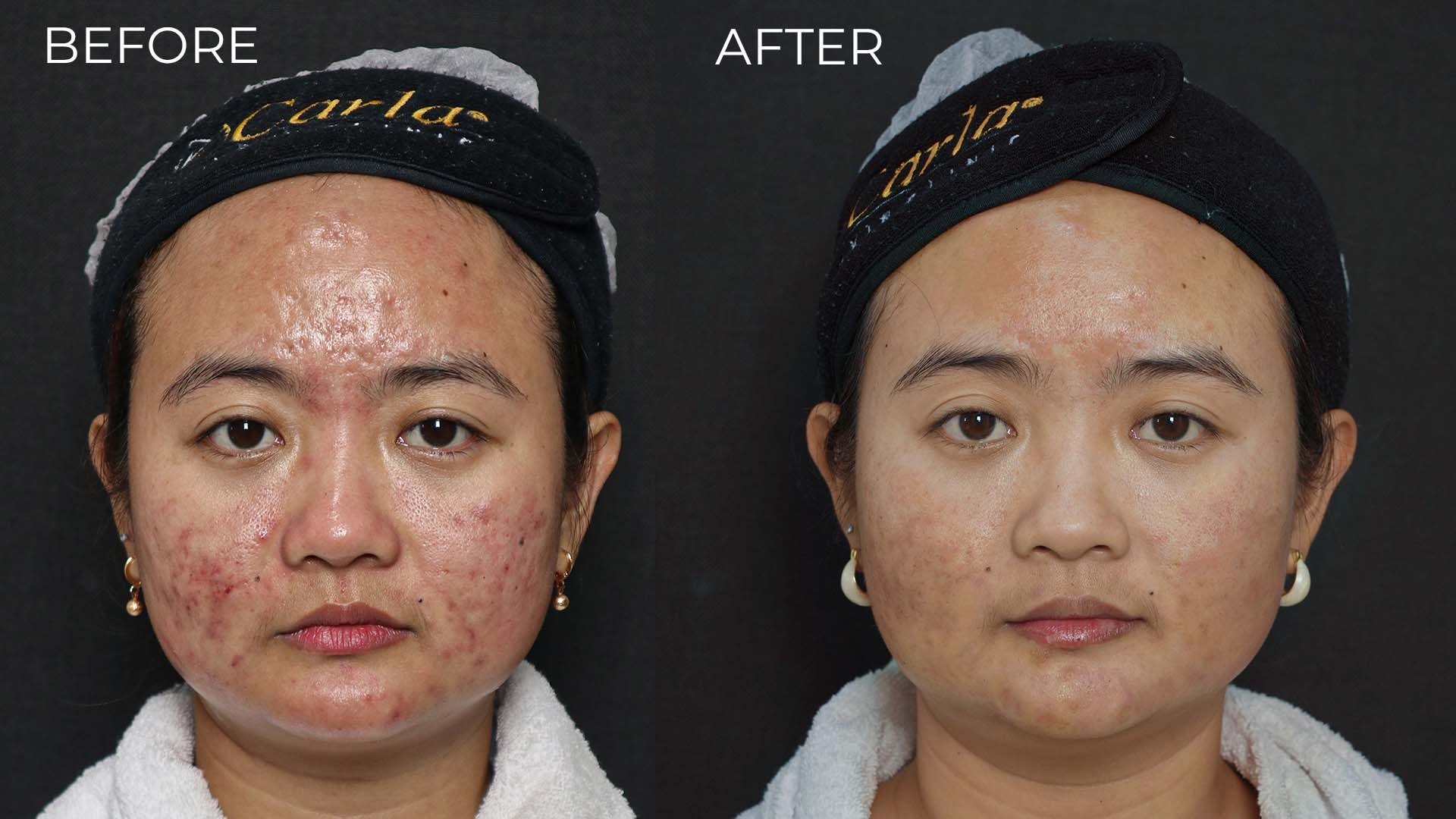 Carla Skin Clinic Hadirkan Trifill Scar Revival dengan Tagline "Scar Repair, Perfected", Solusi Modern untuk Perawatan Bekas Jerawat dan Bopeng